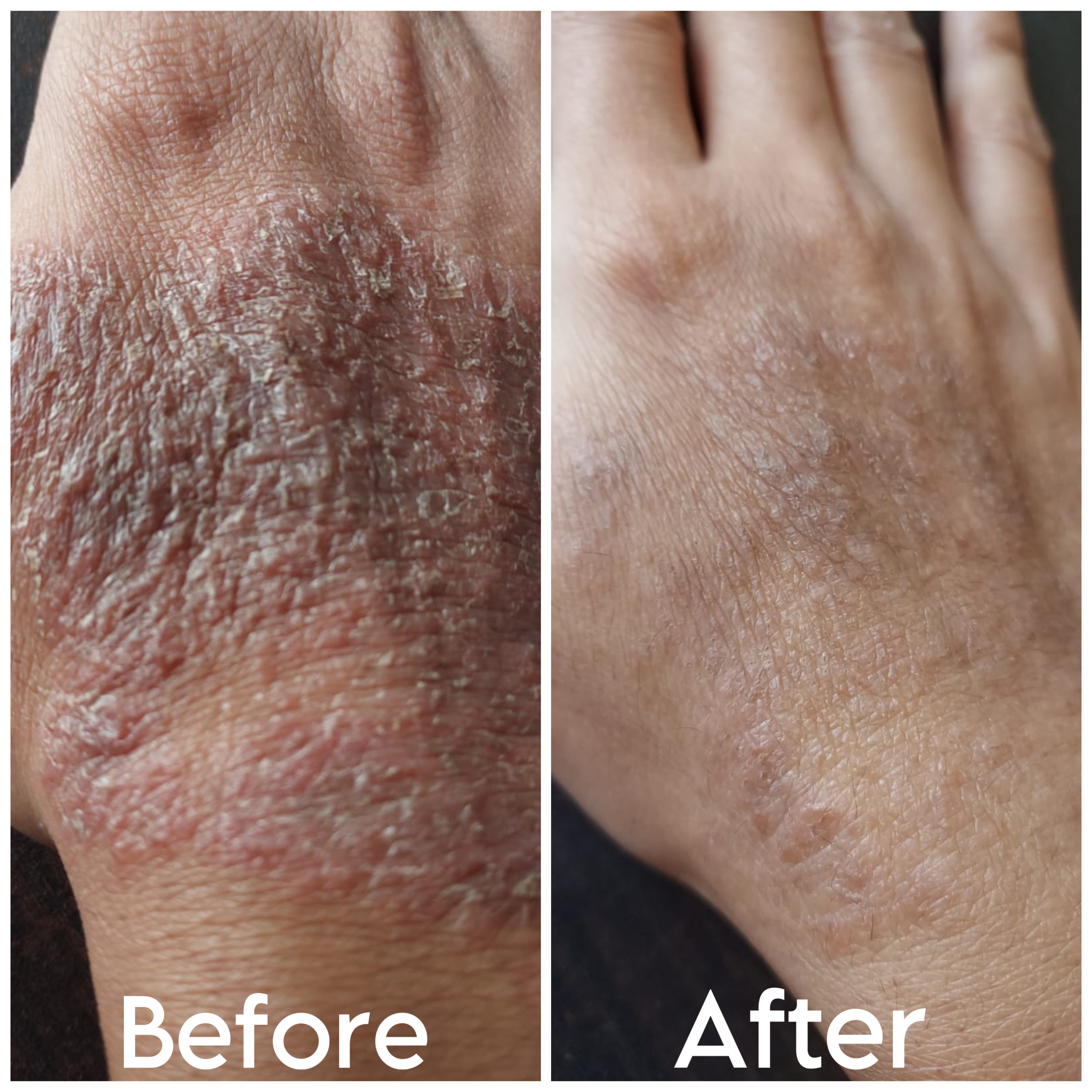 Skin Treatment