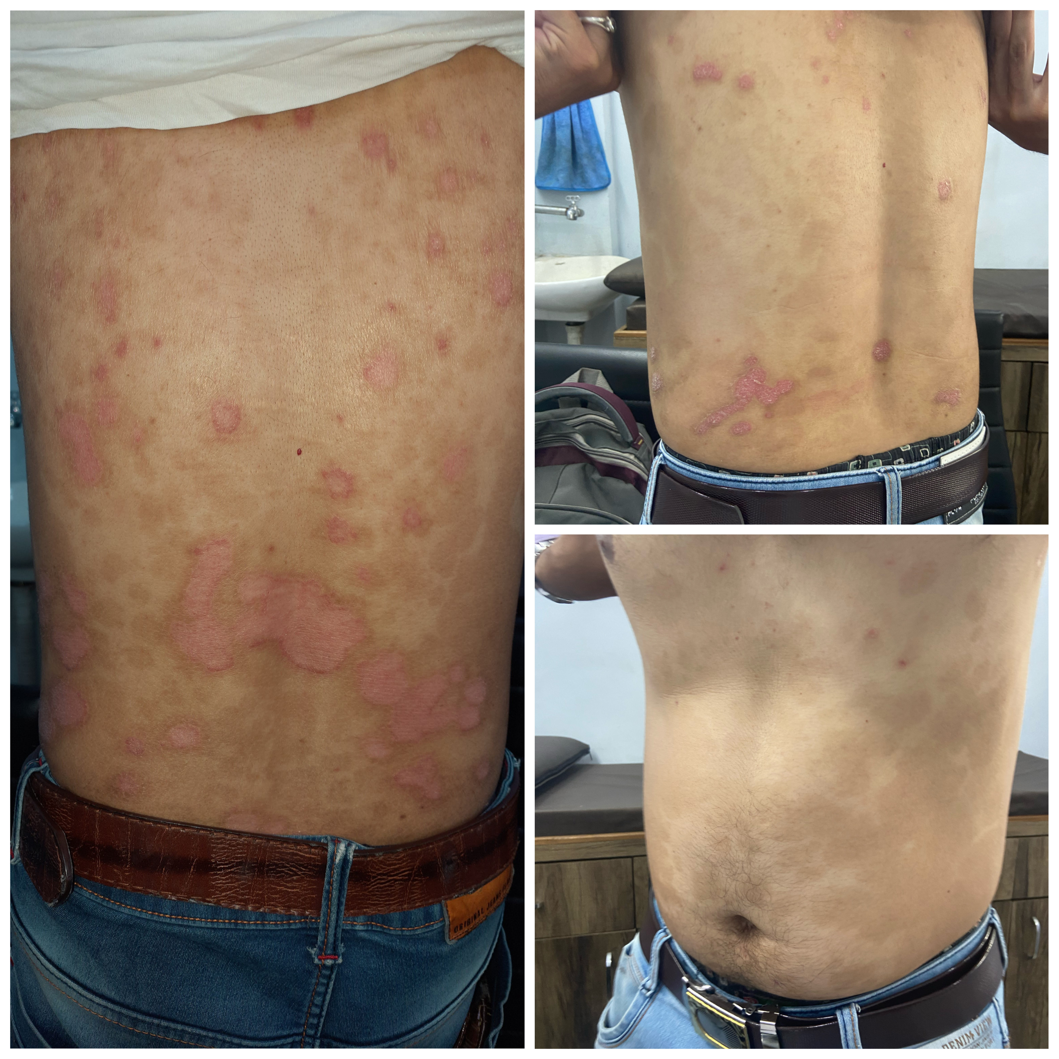 Sporiasis Treatment